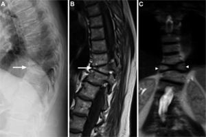 Lateral X-ray of the thoracic spine showing apparent anterior wedge compression fractures at the D10 level (A, arrow). MRI showing, in the sagittal T1-weighted sequence, anterior wedging similar to that seen on the radiograph (B, arrow), but the coronal sections show that it actually corresponded to a defect in the fusion of the vertebral body, which originated the presence of 2 hemivertebrae, the right slightly smaller than the left, with the typical appearance of a “butterfly vertebra” (C, arrowheads).