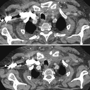 Case 4. Two sequential sections of the upper thoracic CT. Limits of the articular capsule (white arrows), involvement of subcutaneous soft tissue (asterisks) and deviation of the airway (open arrow) can be seen.