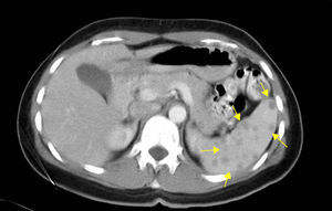 Abdominal contrast CT scan, which shows multiple spleen lesions with no contrast uptake (arrows).