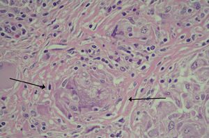 Microscopic histology of the spleen with non-casefying granulomas (arrows).