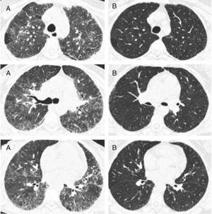 Representative images of HRCT scan after and before treatment with prednisone and DMARDs. (A) Basal HRCT images, showing bilateral ground-glass images, centroliobular nodules and lobular areas of decreased attenuation. (B) There is a general improvement of the ground glass and no images of centroliobular nodules and lobular areas of decreased attenuation. The patient was treated with prednisone, methotrexate and sulphasalazine. There is a difference of 16 months between basal HRCT (A) and follow-up HRCT (B).