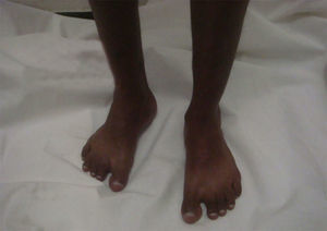 Patient with Noonan's syndrome, with bilateral tibial edema.