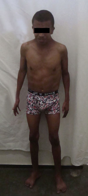 Patient with Noonan's syndrome phenotype (short stature, short neck, chest deformity, and characteristic triangular face with broad forehead).