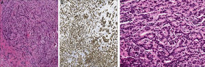 (A) Hematoxylin–eosin (4×); tumor cells with hyperchromatic nuclei are observed. (B) Immunohistochemical staining (4×) cells with expression of E-cadherin, surrounded by a desmoplastic stroma. (C) At higher magnification (20×), other areas of the cylinder forming gland precursors infiltrating the interstitium, which is fibrous and shows an inflammatory reaction, may be seen.