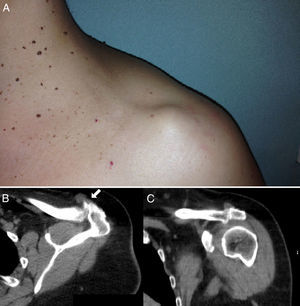 (A) External appearance of the tumor. (B) Shoulder CT, through the acromioclavicular joint, in which communication between the joint and the tumor (arrow) is seen. (C) Coronal section through the acromioclavicular joint with capsular distension.