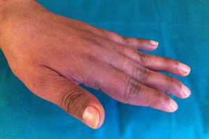 Left hand of the patient with Jaccoud's arthropathy where ulnar deviation of the 5th finger and swan neck deformity of fingers 2–5 is appreciated.