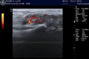 Longitudinal view of the palmar radiocarpal joint, in which the flexor tendons of the wrist are appreciated. A hypoechoic thickening of the synovial sheaths of the tendons is highlighted, corresponding to tenosynovitis with marked synovial hypertrophy and a pathological Doppler signal, which shows an increase of normal vasculature.