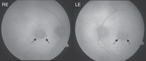 Retinography autofluorescence of the patient at the time of diagnosis of antimalarial associated maculopathy. There is an incomplete concentric macular pigmentary disturbance alteration (arrows). RE: right eye; LE: left eye.