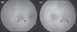 Retinography autofluorescence of the patient at the time of diagnosis of antimalarial associated maculopathy. There is an incomplete concentric macular pigmentary disturbance alteration (arrows). RE: right eye; LE: left eye.