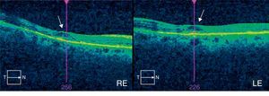 Optical coherence tomography of the macula of the patient at the time of diagnosis. ‘Flying saucer’ sign, typical of antimalarial maculopathy (arrows).