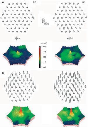 Central multifocal electroretinogram of both eyes of the patient. (A) At the time of diagnosis. (B) One year after cessation of treatment with hydroxychloroquine. Note the normalization of the waves and its graphical representation in the color scale.