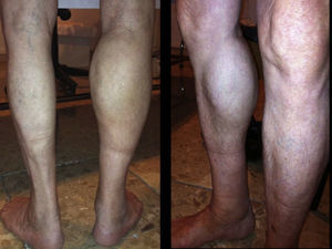 Gastrocnemius asymmetry.