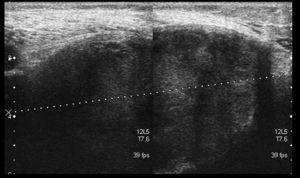 Ultrasound. Transversal view. Heterogeneous popliteal cyst. Appearance corresponding to fibrinous blood clot.