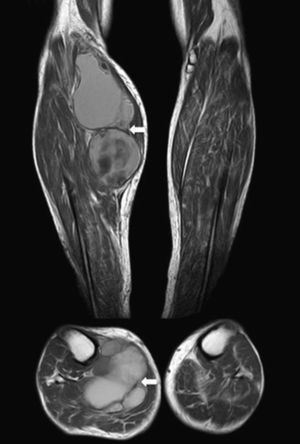 MR. Axial and coronal T1-weighted images. Well circumscribed mass (arrows). Increased intensity signal compatible with a subacute presence of blood products.