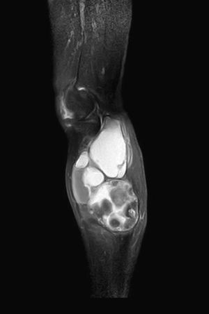 MR. Sagittal T1-weighted image with fat saturation. Peripheral potentiation is observed compared to the precontrast image but no significant image central enhancement, indicating its cystic nature.
