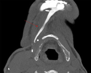 Axial maximum intensity projection (MIP) showing abnormal linear calcification.