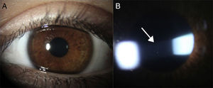 (A) Eye with chronic anterior uveitis associated with JIA without showing evidence of inflammation upon superficial examination. (B) Same eye under slit lamp examination showing Tyndall phenomenon (protein exudation) and inflammatory cells (arrow) floating in the aqueous humor of the anterior chamber.