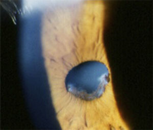 Extensive posterior iris synechiae and cataract formation secondary to persistent intraocular inflammation and topical steroid use.