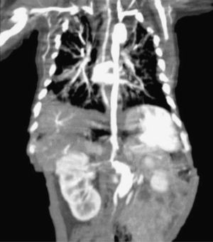 The presence of aneurysms at the descending and abdominal aorta level can be seen.