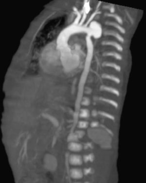 Descending aortic arch aneurysm.