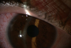 Anterior uveitis with perikeratic injection.