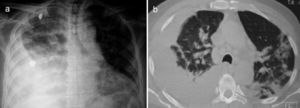 (a) Chest X-ray showing a right-sided pleural effusion. (b) The computed tomography showed left lung pulmonary opacities besides the pleural effusion.