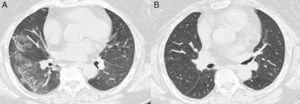 Thoracic CT scan. (A) Clinical onset. (B) Control.