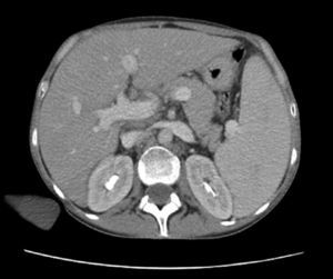 CT scan of the abdomen showing hepatomegaly and dilated portal and splenic veins.
