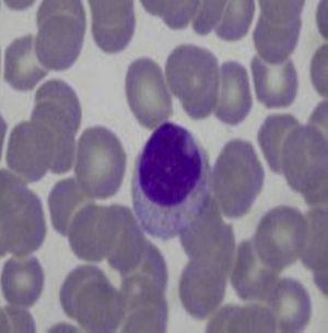 Peripheral blood smear: large granular lymphocytes.