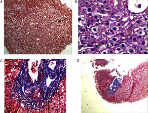 Liver biopsy. (A) Masson trichrome (×4) where signs of hepatocyte regeneration without intervening sinusoids and no evidence of fibrosis was observed. (B) Focus of intrahepatic cholestasis. (C and D) Liver parenchyma with preserved portal space.