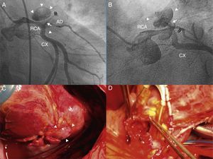 Pseudoaneurysm of left main coronary artery. (A) Left coronary right anterior oblique projection. RCA, right coronary artery; CX, circumflex; AD, anterior descending. The arrow indicates the neck of the pseudoaneurysm, limited by arrowheads. (B) Coronary flow in the left oblique projection. (C) Image of the pseudoaneurysm from the position of surgeon. (D) Open pseudoaneurysm.