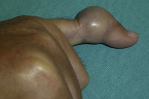 Clinical appearance of the fifth finger of the patient.
