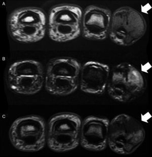 Axial MRI scanning, showing a hypointense lesion on T1 (A) and hyperintense on T2 (B), with slight enhancement after contrast administration (C).