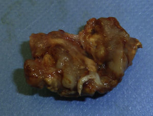 Macroscopic appearance of the lesion, after excision of nodular tissue and of a yellow-brownish color.