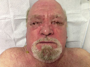 Facial and neckline erythema.