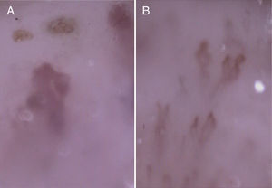 Capillaroscopy showing bleeding in multiple areas, capillary thrombosis and two large megacapillaries (A) and moderate-severe expansion alternating with single minimal dilations and simple tortuosity (B) without avascular areas.