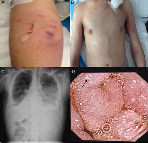 (A) Pathergy phenomenon. (B) “Caput medusae”. (C) Chest X-ray of anteroposterior projection shows bilateral pleural effusion. (D) Capsule endoscopy: intestinal lymphangiectasia.