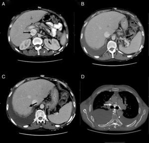 (A) Computed axial tomography: shows caudal vena cava heterogenicity. (B) Computed axial tomography: shows collateral circulation in the splenic hilum. (C) Computed axial tomography: shows suprahepatic repletion defect. (D) Axial angiotomography: shows mediastinal collateral circulation.