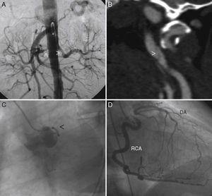 (A) Abdominal aortography evidencing proximal stenosis at both renal arteries level (arrowhead). (B) Angiography by computed tomography where it is possible to observe left carotid artery dissection (arrowhead). (C) Left coronary catheterization (left anterior oblique) where only a poor-developed circumflex artery can be seen (arrowhead). (D) Right coronary catheterization (left anterior oblique) that evidences a dominant right coronary artery (RCA) that fills for collateral circulation of descending artery (DA), which is occluded at proximal level.