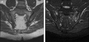 Semicoronal T1 and STIR sequence MRI cuts of the sacroiliac joint. (A) T1 sequence shows clear irregularities and subchondral bone erosions in both sacroiliac joints, as well as sacroiliac focal sclerosis in the left joint. (B) STIR sequence with a hyperintense signal corresponding to subchondral bone marrow edema (arrows), more severe on the left ilium and sacrum, and with less involvement in the anterior segment of the right sacroiliac joint, compatible with active sacroiliitis.