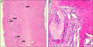 Biopsy showing the histology of the sacroiliac joint. (A) various intraosseous tophi (arrows) are observed. (B) At higher magnification, an intraosseous tophus formed by a center with urate crystals, surrounded by inflammatory reaction and multinucleated giant cells may be seen.