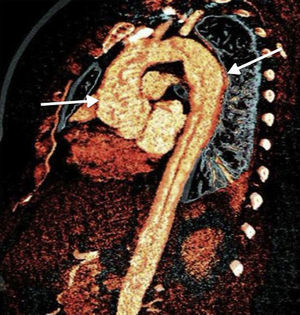 Aortic reconstruction by magnetic resonance imaging indicating dilated portion of aortic arch. Patient with IgG4-related sialoadenitis with aortic involvement.