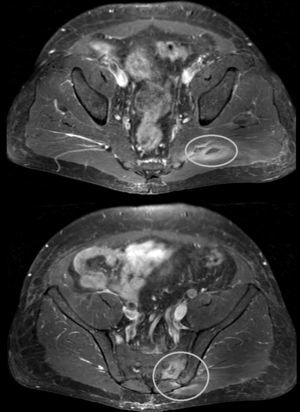 Magnetic resonance imaging of pelvis.