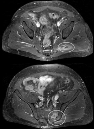 Magnetic resonance imaging of pelvis.