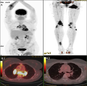 Nuclear medicine study of case no. 1. (A) Scintigraphic study showing an active inflammatory process affecting upper and lower limbs, mediastinal lymph nodes, lung parenchyma, bone and left gluteal muscle. (B.1) Positron emission tomography (PET) study showing mediastinal lymph node involvement prior to treatment. (B.2) PET study following treatment.