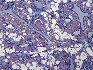 Amyloid depositions showing the characteristic Congo red staining.