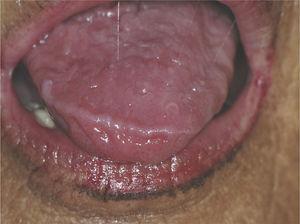 Seventy-year-old woman with primary Sjögren