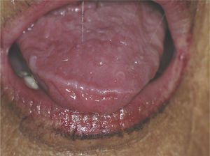 Seventy-year-old woman with primary Sjögren's syndrome with hyposalivation. Note the stringy aspect of the saliva.