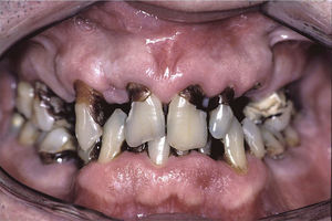 Patient with primary Sjögren's syndrome-related hyposalivation and a great number of caries.