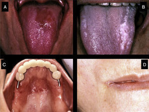 Types of oral candidiasis that can develop in primary Sjögren
